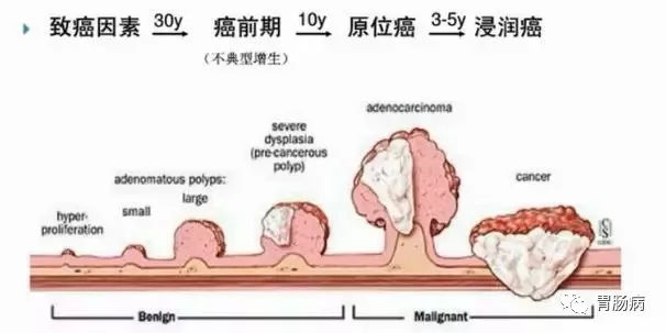 體檢查出腸息肉一定要切除！ 95%腸癌由它演變而來(lái)