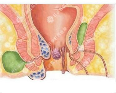 南寧哪個(gè)醫院可以做肛周膿腫？