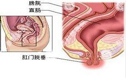 南寧治療脫肛哪家醫院好？南寧脫肛治療多少錢(qián)？